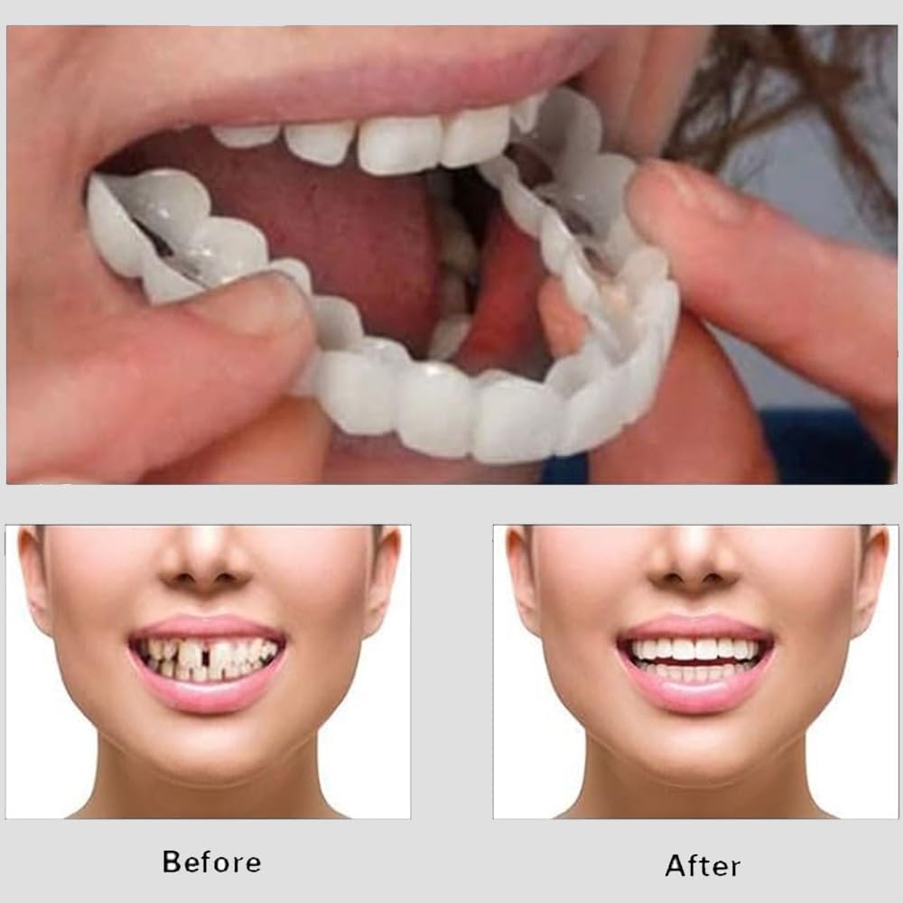 CARILLAS DENTALES-SNAPON SMILE